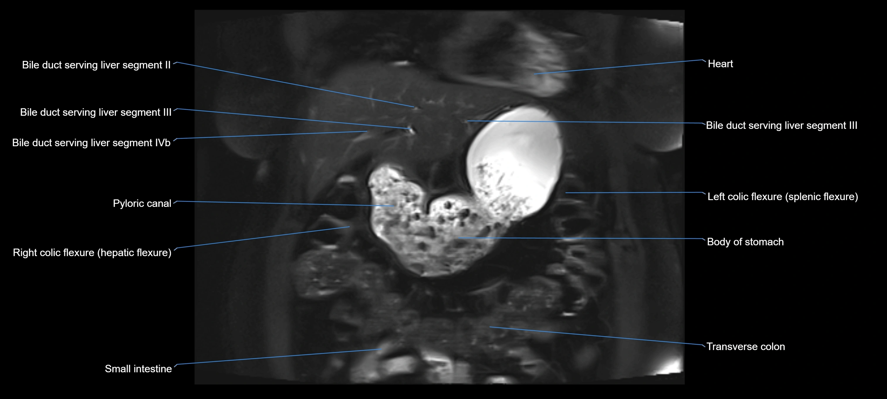 MRI MRCP coronal cross sectional 3T radiology  image-img-00001-00004.webp